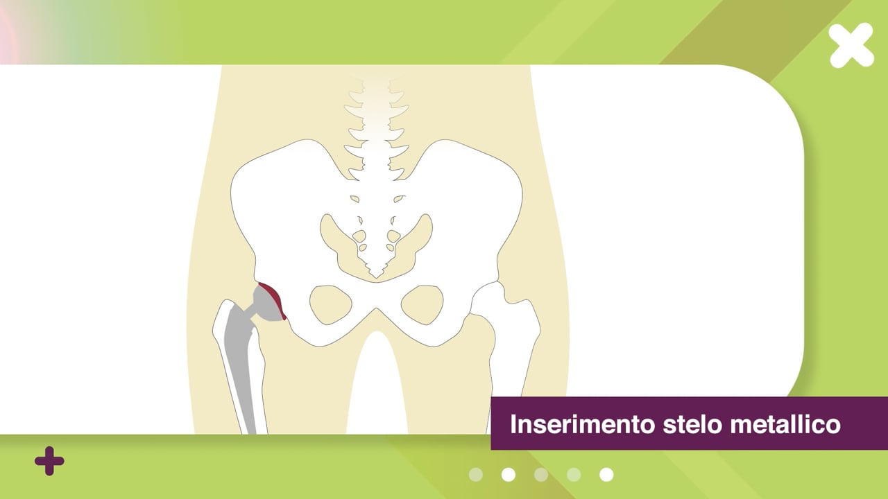 Intervento di protesi dell’anca - Az. Sanitaria Alto Adige